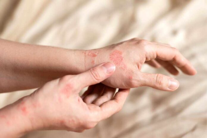 Close-up of a person's hands showing skin irritation and redness
