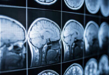 Brain Secrets of SuperAgers Unveiled Close-up of MRI brain scans displayed on a screen