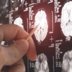 Alzheimer’s Secret Destruction Phase Revealed A hand pointing at a brain MRI scan on a screen