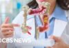 What's fueling the rise of colon cancer in young people