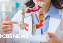 What's fueling the rise of colon cancer in young people