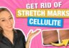 How to Get Rid of Stretch Marks, from a Dermatologist! How to Get Rid of Stretch Marks & Cellulite from a Dermatologist! | Dr. Shereene Idriss