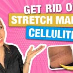How to Get Rid of Stretch Marks & Cellulite from a Dermatologist! | Dr. Shereene Idriss