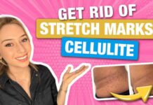 How to Get Rid of Stretch Marks, from a Dermatologist! How to Get Rid of Stretch Marks & Cellulite from a Dermatologist! | Dr. Shereene Idriss