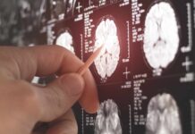 Rare Movement Disorder – Breakthrough Discovery A hand pointing at a brain MRI scan on a screen