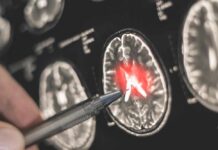Hidden Brain Gatekeeper Upends Alzheimer’s Playbook A hand pointing at a brain scan with highlighted areas