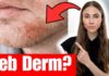 Dandruff in Beards: Causes and DIY Treatments Dermatologist Explains How To Treat Seborrheic Dermatitis (Dandruff, Flaky Scalp, Eyebrows & Beard)