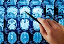 Stress Hormone Joins Brain Repair Crew Hand pointing at brain MRI scans with a pen