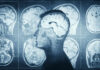 What science says about concussions and death risk MRI scans of the brain displayed alongside a silhouette of a human head