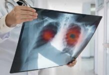 Non-Smokers Hit With Wild Lung Cancer Spike Doctor holding chest X-ray with highlighted lung areas