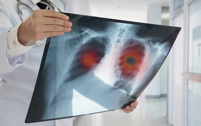 shutterstock_626631452 Doctor holding chest X-ray with highlighted lung areas