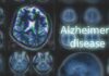 Genetic Wild Card Upends Alzheimer’s Playbook Brain MRI scans with highlighted section and text overlay