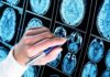 Hand with pen pointing at brain MRI scans