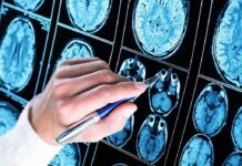 Alzheimer’s Map Stuns – One Brain, Two Stories Hand with pen pointing at brain MRI scans