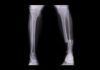 Inside Bones: How Broken Bones Heal leg x-ray showing tibia and fibula fracture