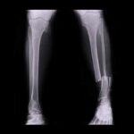 Inside Bones: How Broken Bones Heal leg x-ray showing tibia and fibula fracture