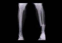 Inside Bones: How Broken Bones Heal leg x-ray showing tibia and fibula fracture