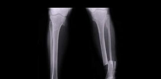 leg x-ray showing tibia and fibula fracture