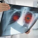 Fat Bubble Hack Stuns Lung Cancer Doctor holding chest X-ray with highlighted lung areas